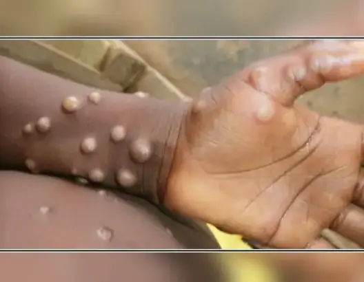 هل نشهد بداية وباء عالمي جديد؟ .. تفشي جدري القرود يتجاوز إفريقيا