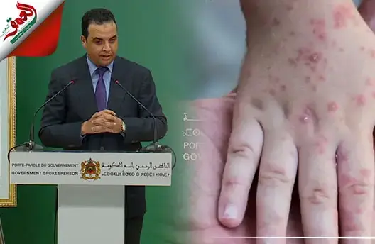 الحكومة تكشف تفاصيل بشأن أول إصابة بمرض جدري القردة بالمغرب
