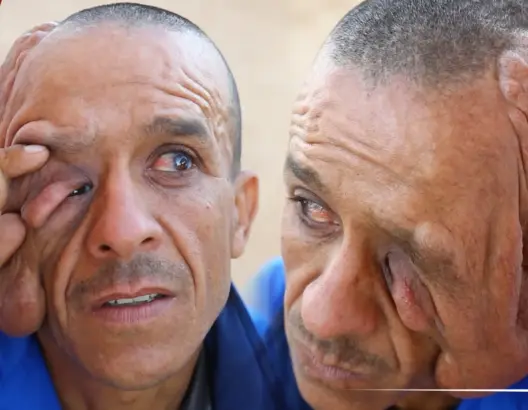 ورم ضخم أفقده البصر ومنعه من العمل.. سعيد من الخميسات ينشد مساعدة المحسنين