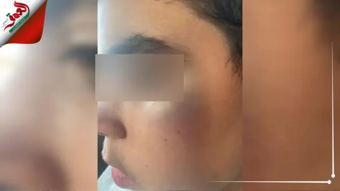 العرائش .. عائلة تشتكي تعنيف طفلها بمؤسسة خاصة