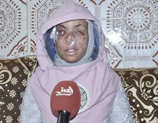 أطفال القمر .. معاناة مع التنمر والإضطهاد ومطالب بالإدماج في المجتمع (فيديو)