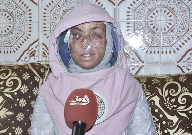 أطفال القمر .. معاناة مع التنمر والإضطهاد ومطالب بالإدماج في المجتمع (فيديو)