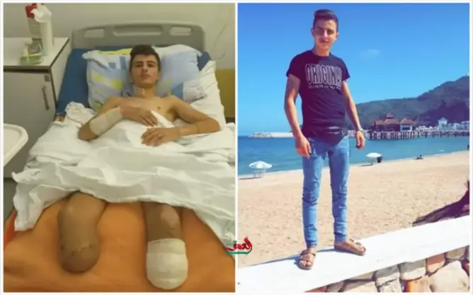 شاب مغربي يتهم الشرطة الصربية بالتسبب في بتر ساقيه.. منشادات لإنقاذه وتحركات لمقاضاة صربيا