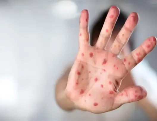 “بوحمرون” يقتل طفلين بأزيلال وسط صمت وزارة الصحة