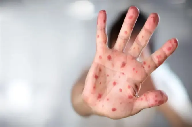 “بوحمرون” يقتل طفلين بأزيلال وسط صمت وزارة الصحة