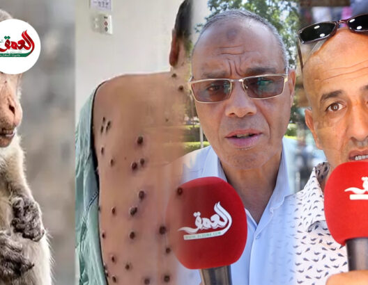 أول حالة جدري القردة بمراكش.. دعوات للحيطة والحذر