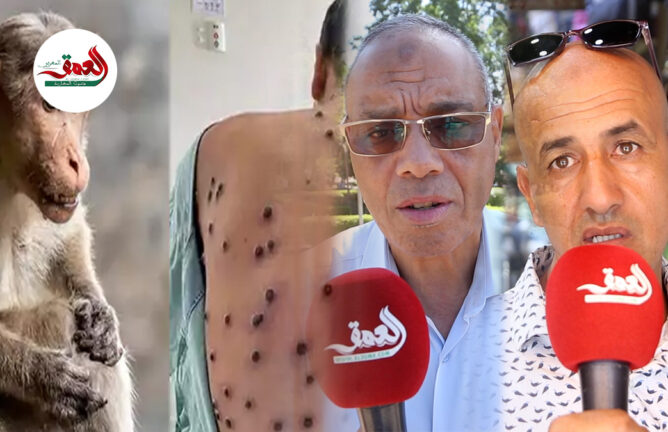 أول حالة جدري القردة بمراكش.. دعوات للحيطة والحذر