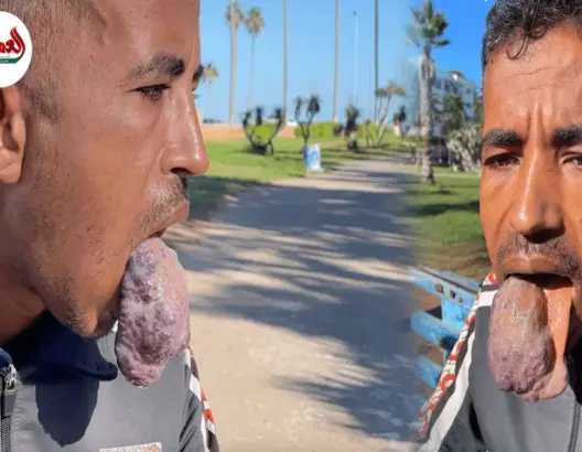 مرض نادر.. ورم في اللسان يحول حياة شاب إلى جحيم