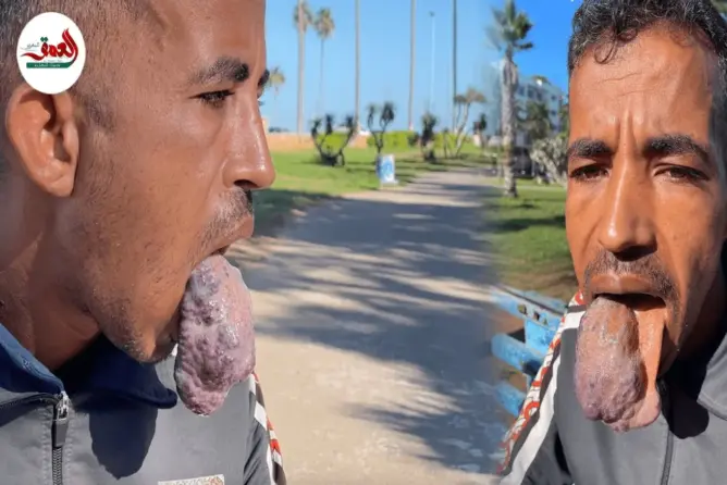 مرض نادر.. ورم في اللسان يحول حياة شاب إلى جحيم