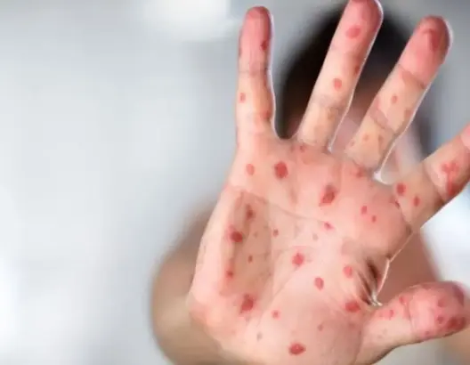 الحكومة ترفض ترويج المغالطات حول “بوحمرون”