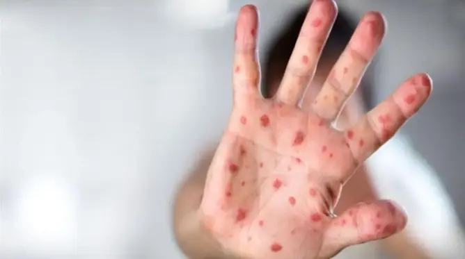 الحكومة ترفض ترويج المغالطات حول “بوحمرون”