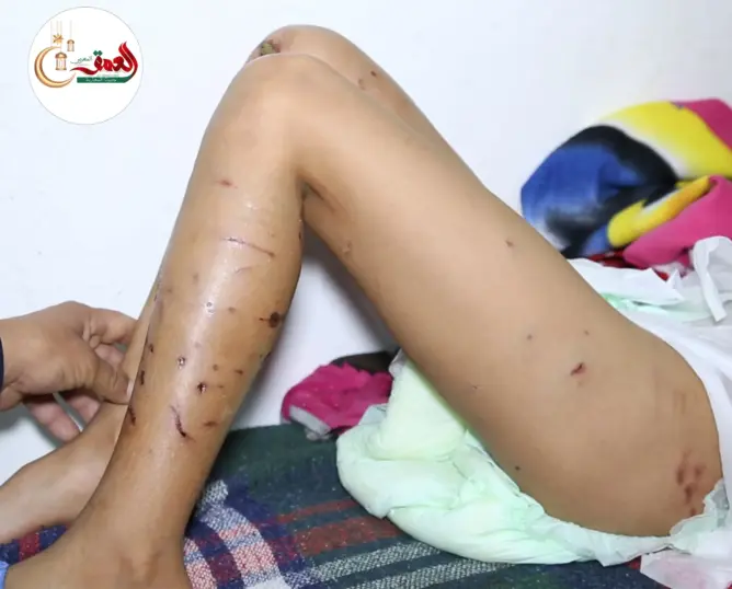 تفاصيل هجوم كلاب ضالة على طفل صغير بفاس