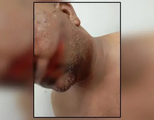 طعنة غادرة تُشوّه وجه بائع فواكه بخريبكة.. ومطالب مهنية بمحاصرة حاملي السلاح الأبيض
