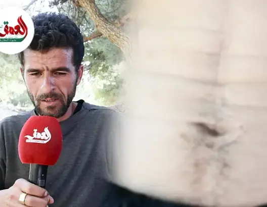 إصابة مواطن بالذخيرة الحية أثناء قتل الكلاب الضالة