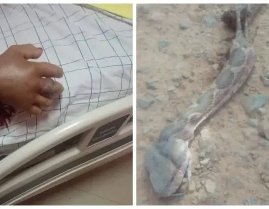 لدغة أفعى سامة ترسل سيدة ستينية إلى مستشفى ورزازات