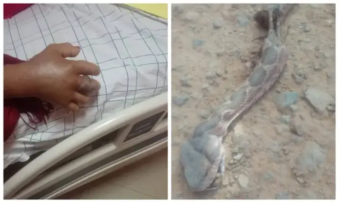 لدغة أفعى سامة ترسل سيدة ستينية إلى مستشفى ورزازات
