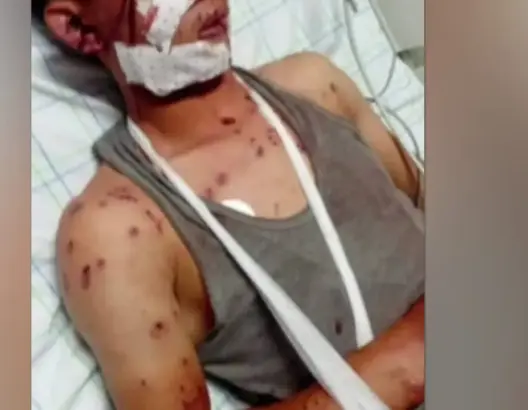 تلقى رصاصة طائشة .. إصابة شاب في رحلة صيد نواحي تنغير