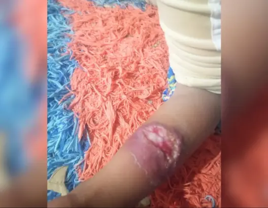 تبلغ 5 سنوات فقط .. طفلة تصارع داء “الليشمانيا” نواحي الرشيدية ومخاوف من تفشي المرض