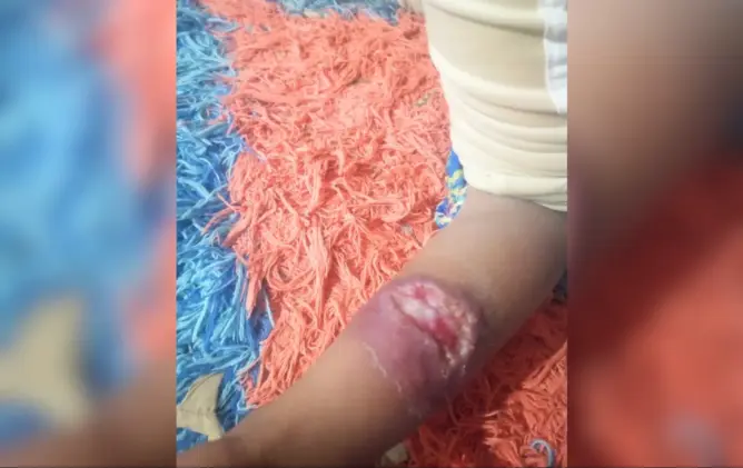 تبلغ 5 سنوات فقط .. طفلة تصارع داء “الليشمانيا” نواحي الرشيدية ومخاوف من تفشي المرض