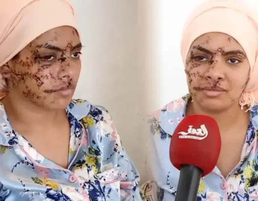 15 سنة سجنا نافذا لمتهم بتشويه وجه طليقته بتازة .. والضحية: “راضية بالحكم”