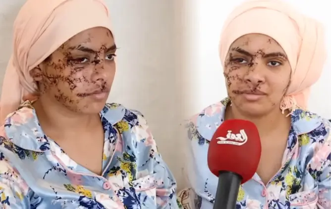 15 سنة سجنا نافذا لمتهم بتشويه وجه طليقته بتازة .. والضحية: “راضية بالحكم”