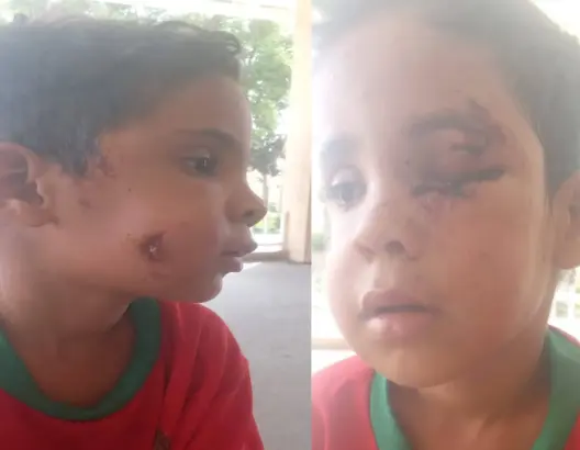 تطورات حالة الطفل “زكرياء” بتارودانت.. جراحة مستعجلة وتحسن تدريجي بعد هجوم مباغت لكلب ضال