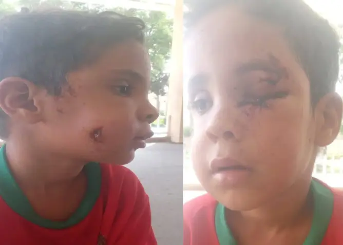 إقليم تارودانت.. كلب ضال ينهش وجه طفل بأحمر الكلالشة