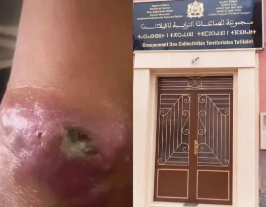 مخاوف من انتشار الليشمانيا في الرشيدية.. ومطالب بتوضيح دور “مجموعة تافيلالت” في الوقاية
